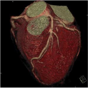 HeartFlowNXT – A szívkoszorúér véráramlás HeartFlow elemzése koszorúér CT angiográfiával