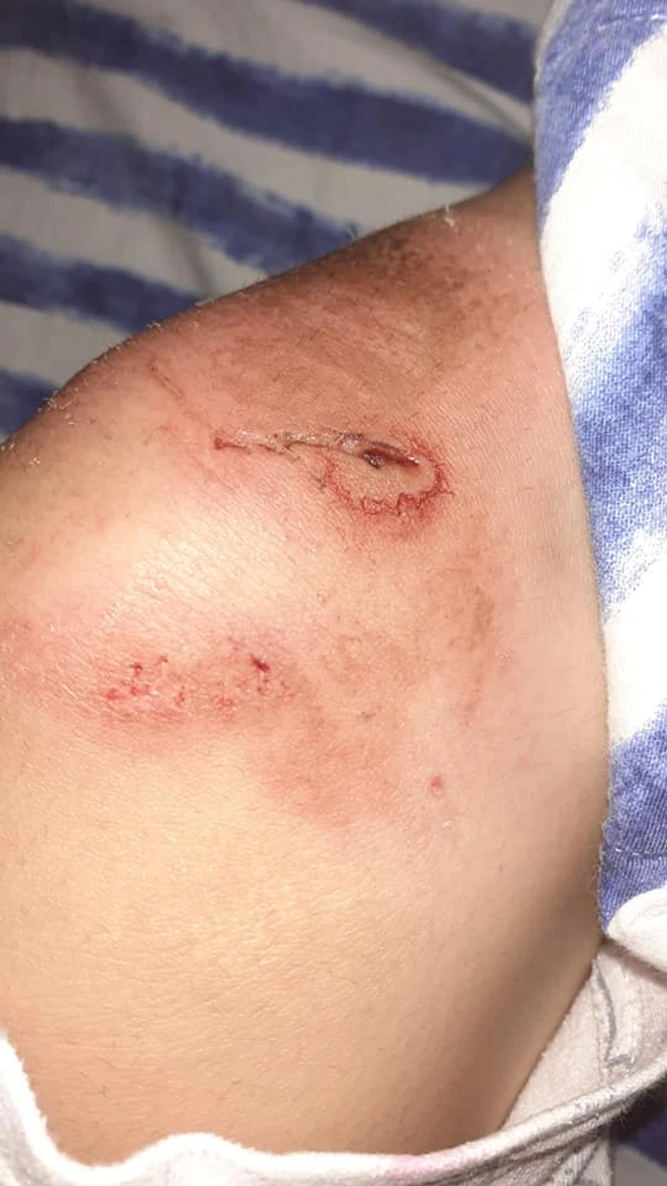 Povrede koje je devojčica zadobila tokom napada psa