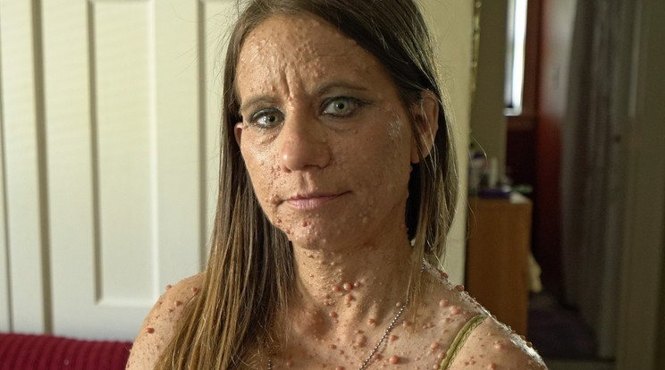 Hihetetlen 6000 tumorral a testén él a nő / Fotó: Profimedia Reddot