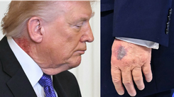 Coś się dzieje ze zdrowiem Donalda Trumpa. Nowe duże, czerwone plamy. Lekarz tłumaczy