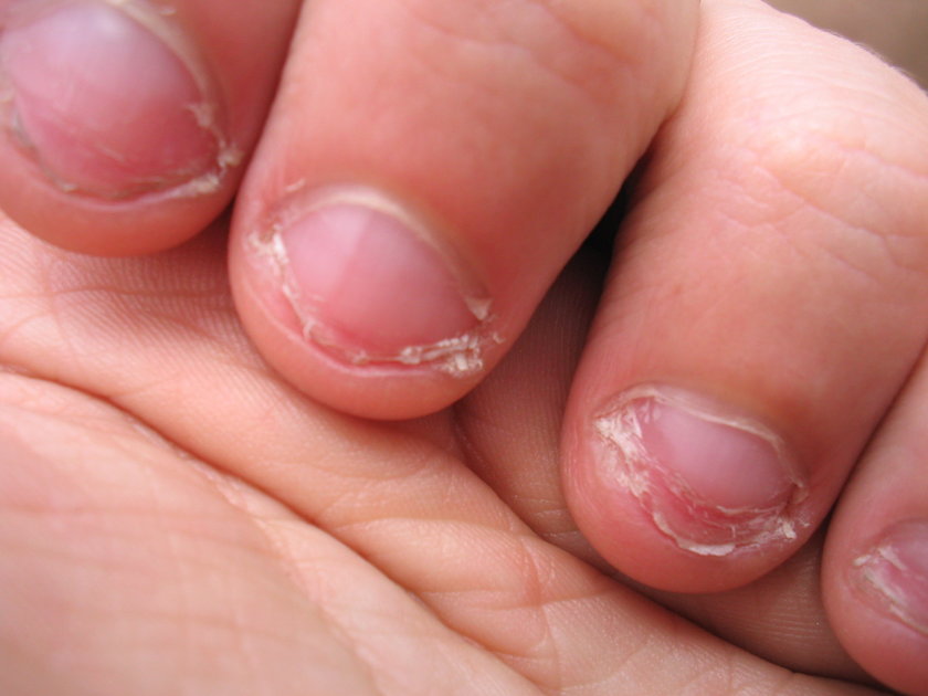 Obgryzanie paznokci może szybko rozwinąć się w poważną dermatofagię