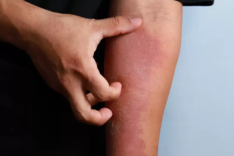 Atopowe zapalenie skóry to coś więcej, niż &quot;wysypka&quot; / Getty Images
