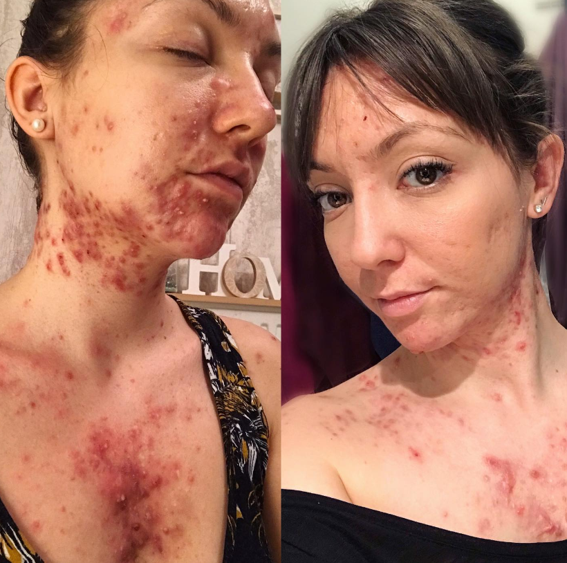 Mandy Nazé strpčovalo život akné. 