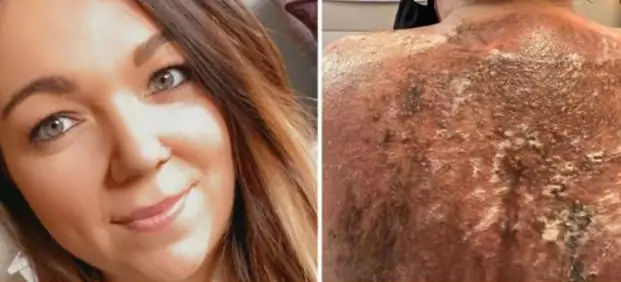 Kobieta pokazała, jak wyglądają jej poparzone plecy Fot. The Sun Facebook prinscreen
