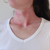 Anafilaxiás sokk: életveszélyes tünetek, amikkel azonnal orvoshoz kell menni!