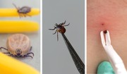 Pinzas, pinzas, lazo o bomba: ¿cuál es la mejor manera de quitar una garrapata?