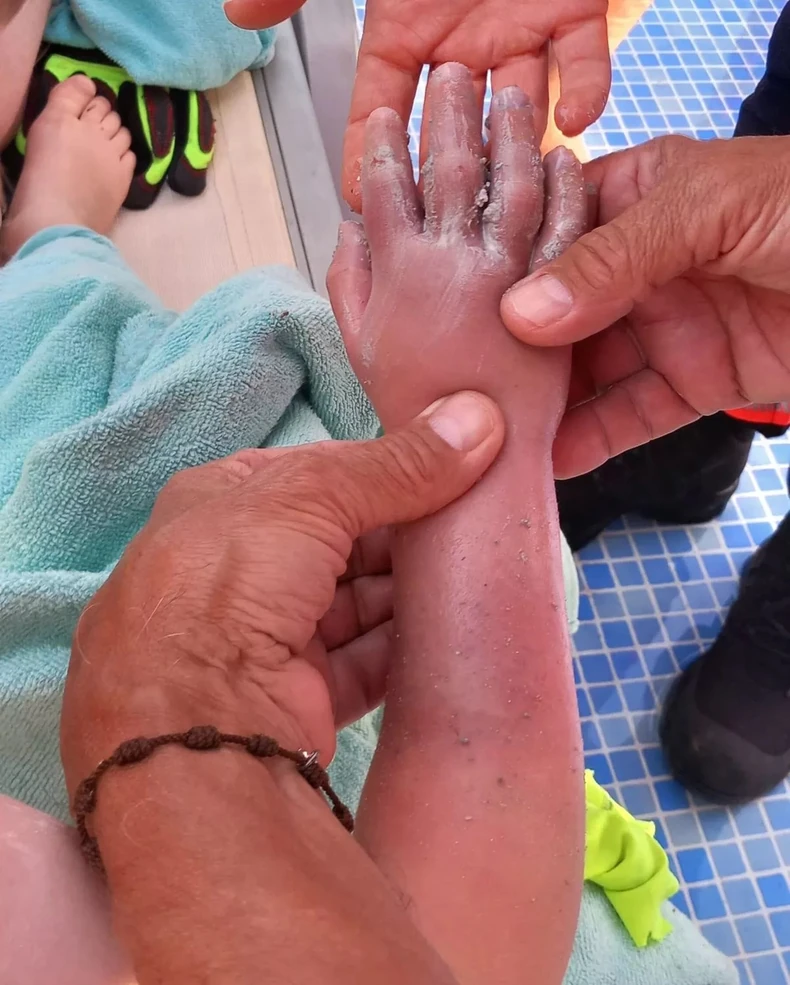 Ruka dečaka nakon što su je izvukli iz odvoda