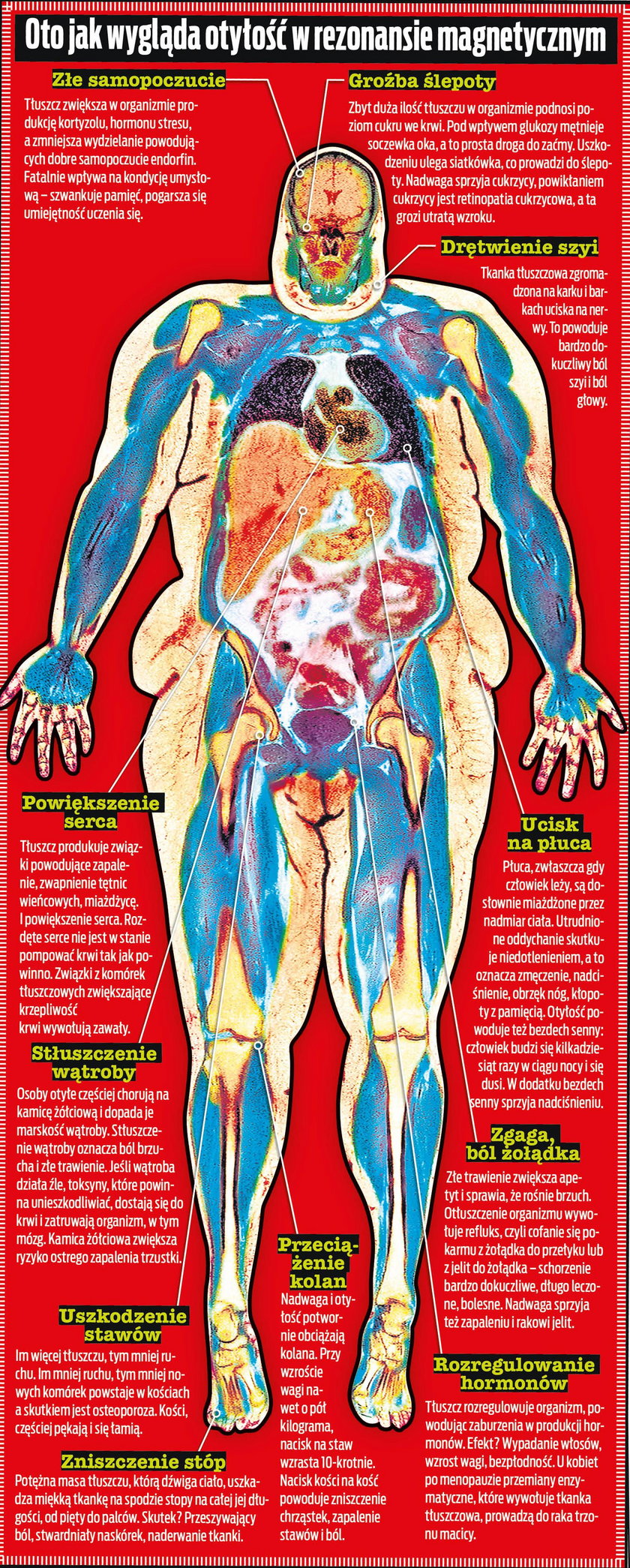  Tak wyglądają konsekwencje otyłości w rezonansie magnetycznym