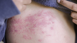 Has a rash on your body?  You may be infected with the BA.4 or BA.5 sub-variant