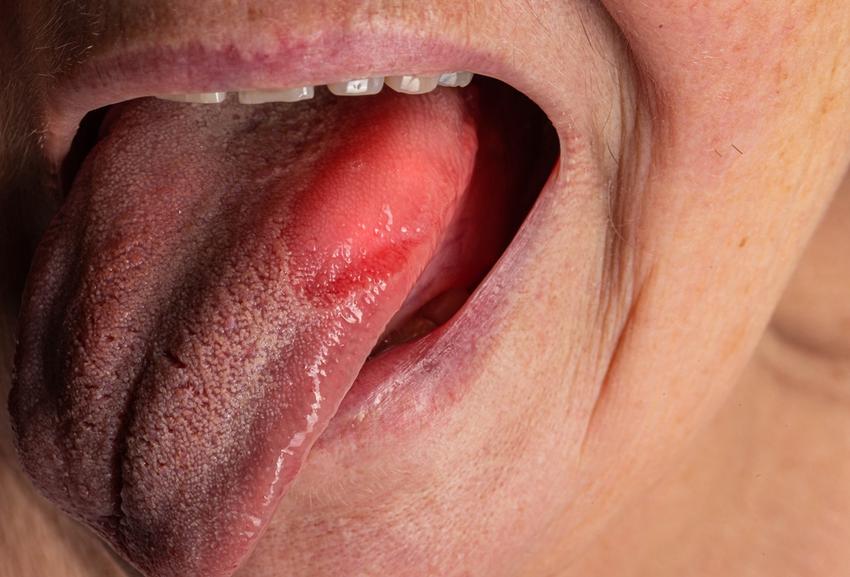 A deficiency of vitamin B12 and folic acid leads to anemia, the first symptoms of which always appear in the mouth.  The epithelium of the tongue atrophies and thins, the tongue becomes burning and painful. 