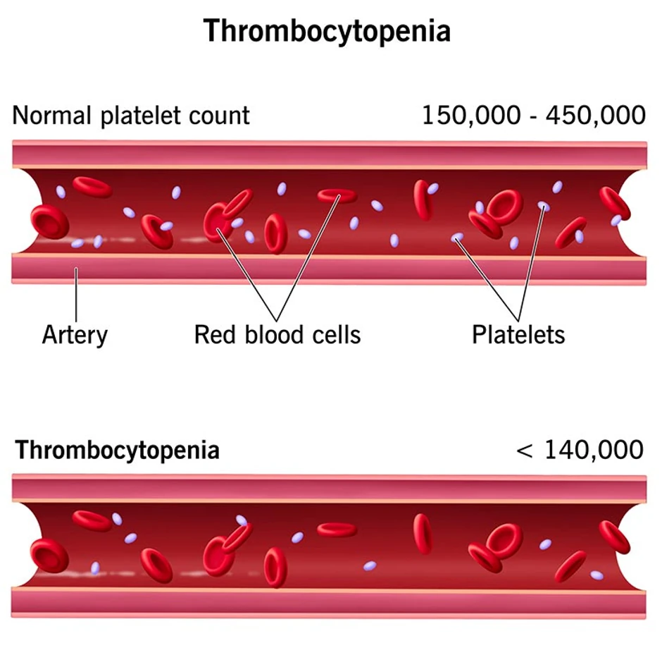 Normalan nivo trombocita kod odraslih je od 150.000 do 450.000 po mikrolitru krvi