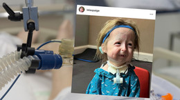 Dziewczynka, która cierpi na chorobę niczym Benjamin Button (screenshot/Instagram/@islaspaige)