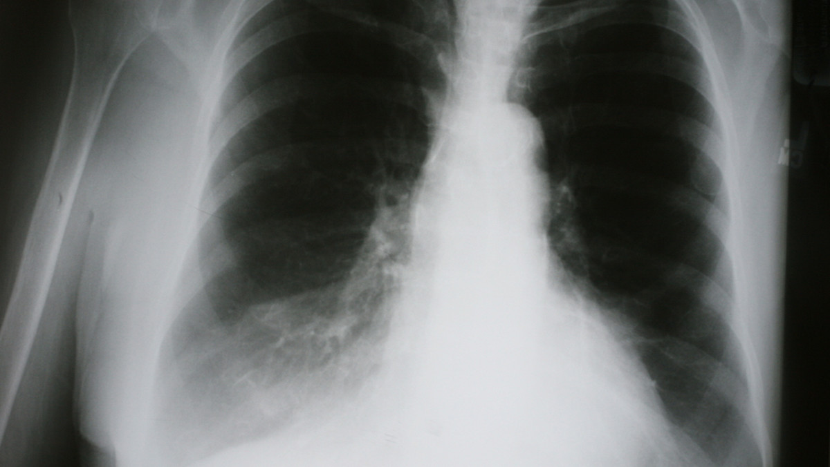 Uzupełnianie niedoborów witaminy D u osób cierpiących POChD (przewlekłą obturacyjną chorobę płuc) może złagodzić objawy tej groźnej choroby o ponad 40 proc. – twierdzą naukowcy z Queen Mary University w Londynie . Wyniki ich badań opublikowało pismo "Lancet Respiratory Medicine".