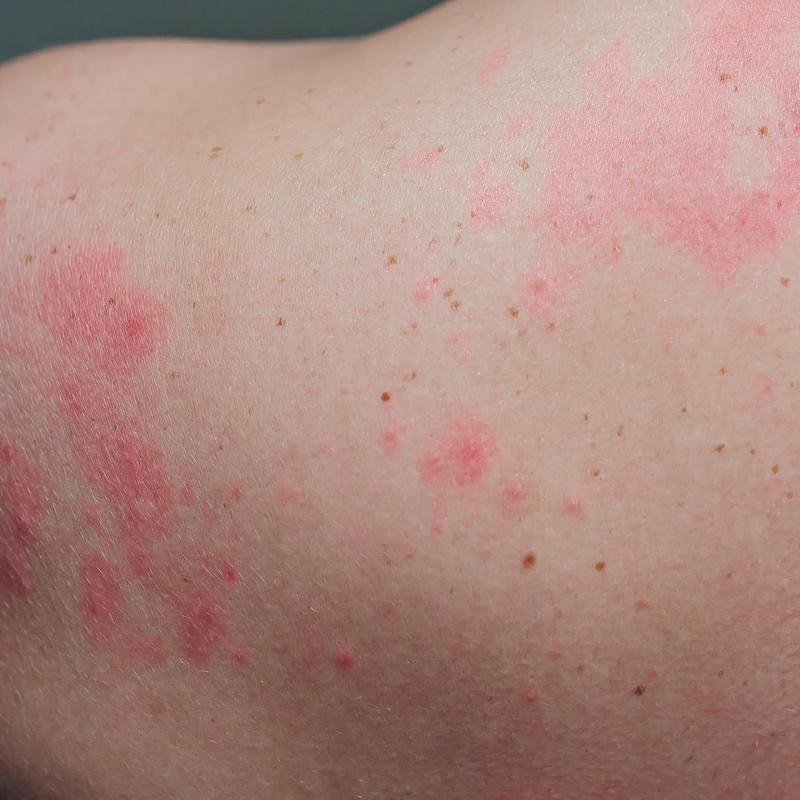 Wysypka Po Antybiotyku Czy To Objaw Alergii