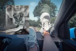Nigdy nie trzymaj tak nóg w samochodzie. Lekarz pokazał zdjęcie