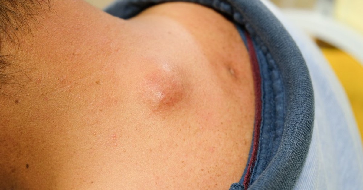 The year's best cyst popping videos, including one that can only be