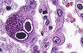 citomegalovirus-d0000140643394a495b2f