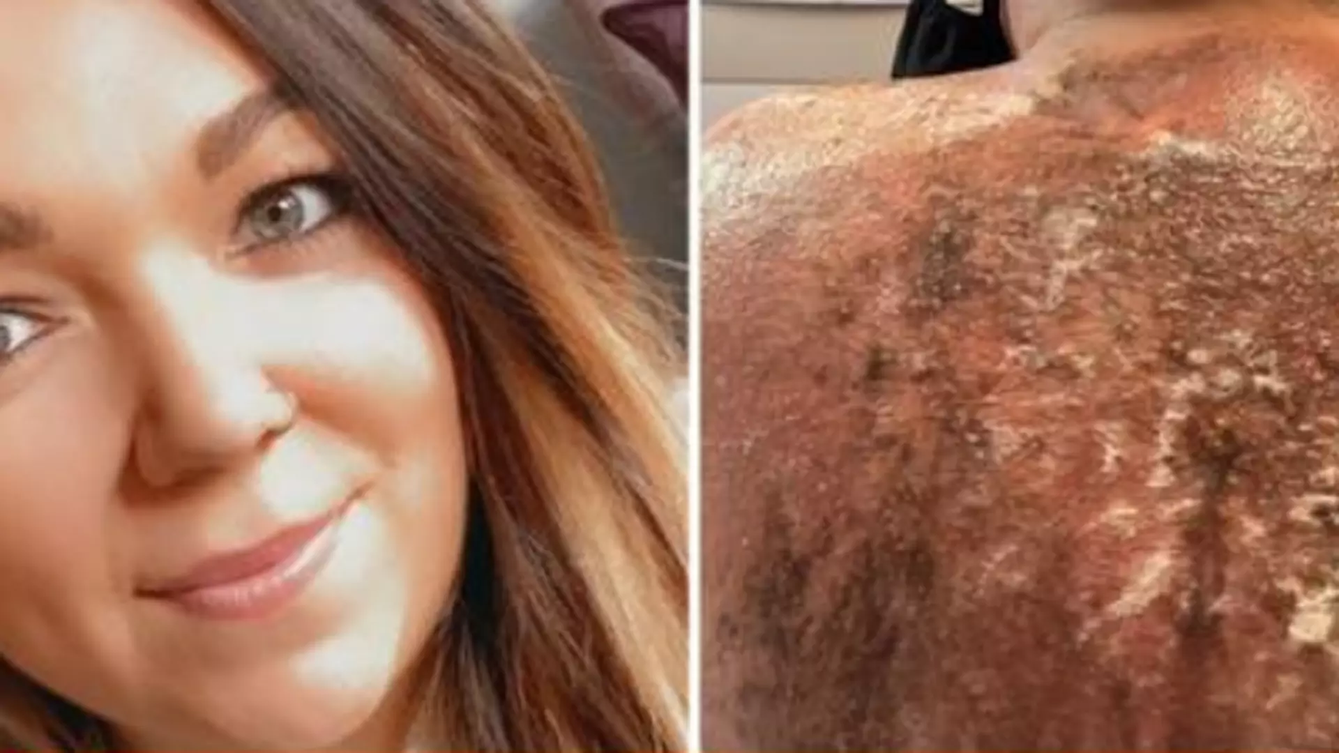 Użyła olejku do opalania, ale jej skóra wygląda tak, jakby kobieta ocalała z pożaru