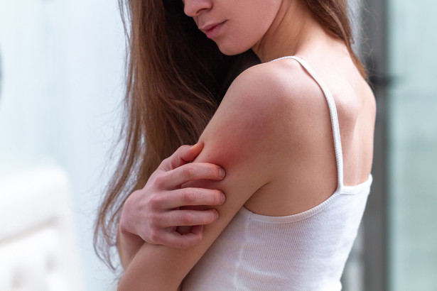 Łuszczyca jest przykładem nieuleczalnej choroby, której początkowe objawy można łatwo pomylić z alergią lub ugryzieniem komara