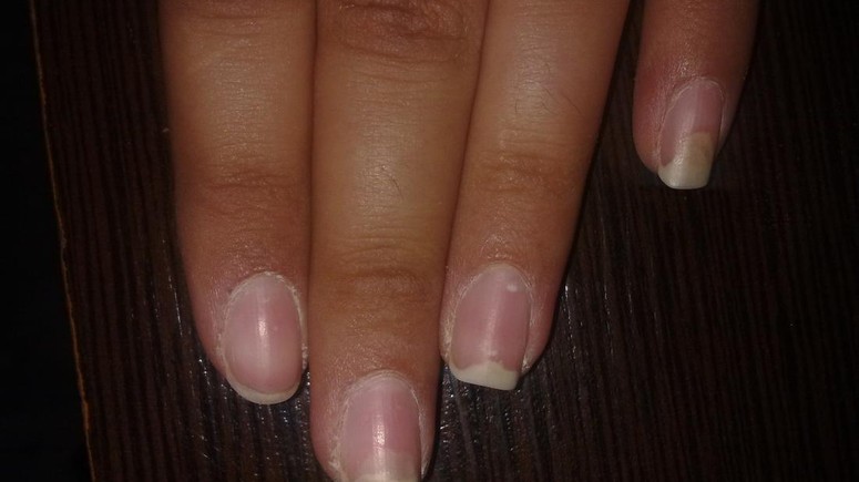Causes And Treatment Of Fingernails Falling Off Pulse Nigeria
