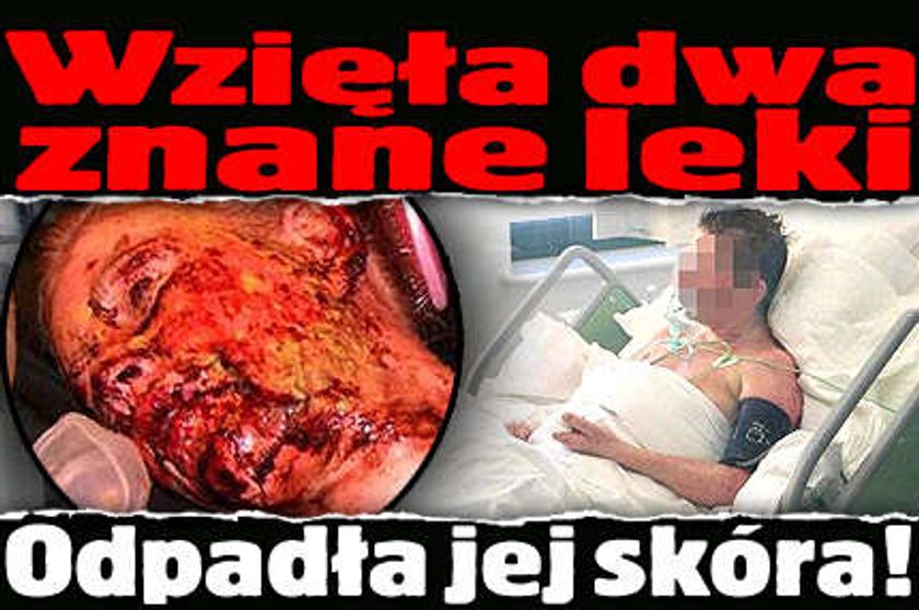 Wzięła dwa znane leki. Odpadła jej skóra!