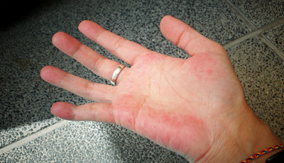 Siedem chorób, które widać na dłoniach