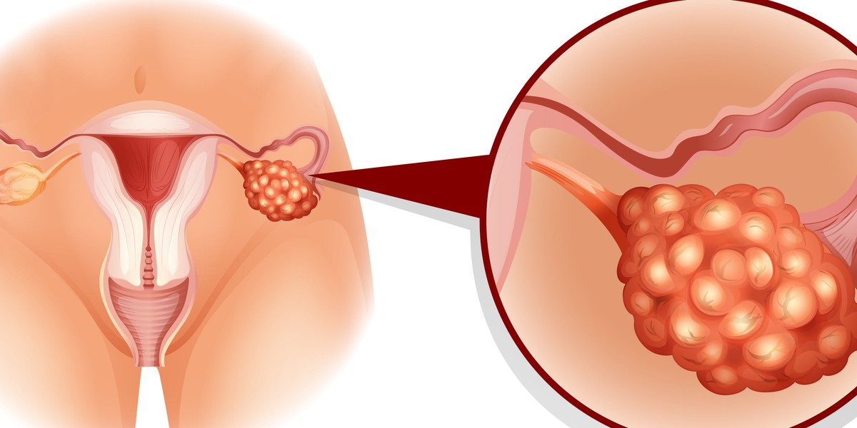 Symptomy Raka Jajnika Można Pomylić Z Problemami Gastrycznymi 8234