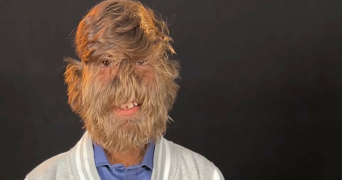 19-latek ma najbardziej owłosioną twarz. Pobił rekord Guinnessa