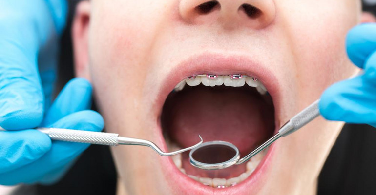 Wybielanie zębów a aparat ortodontyczny. Kiedy najlepiej rozjaśnić zęby? 