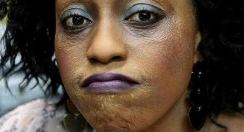 Bleaching has noticeable side effects [modernghana]