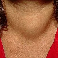 pajzsmirigy-nodula-d000019A548898e0a5788