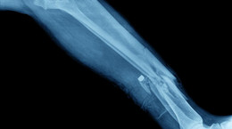Open fracture.  How to help so as not to harm?  The orthopedist advises