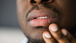 What to know about herpes [TribuneOnline]