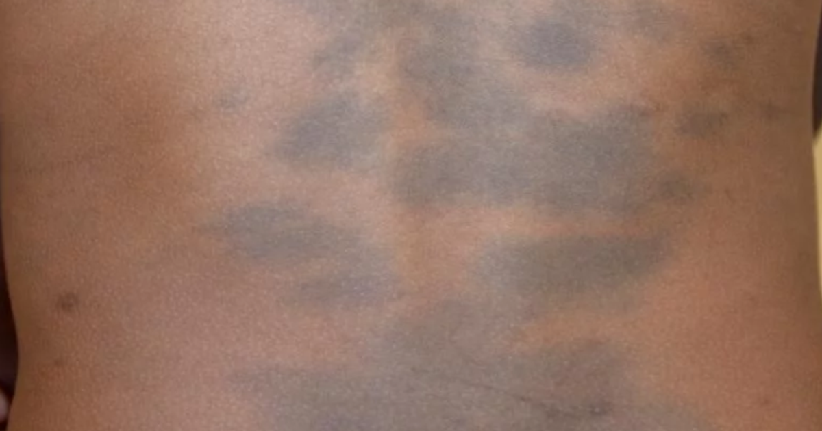 What is a birthmark Everything you need to know Pulse Nigeria