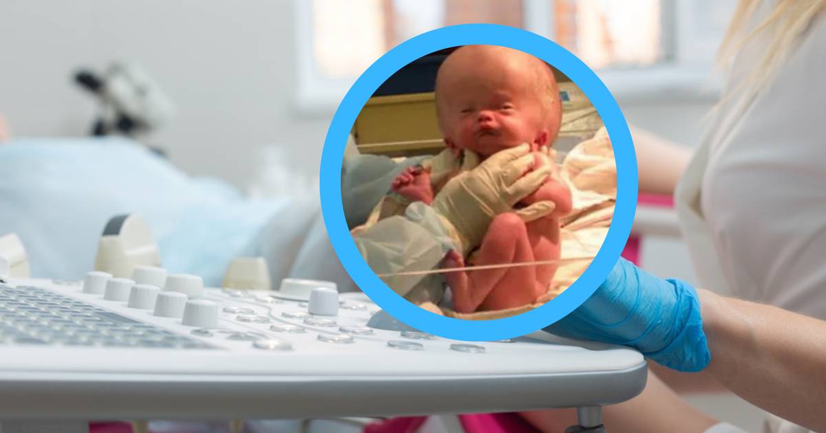 Urodził się z wodogłowiem, miał nie przeżyć porodu. Tak wygląda 16 lat później