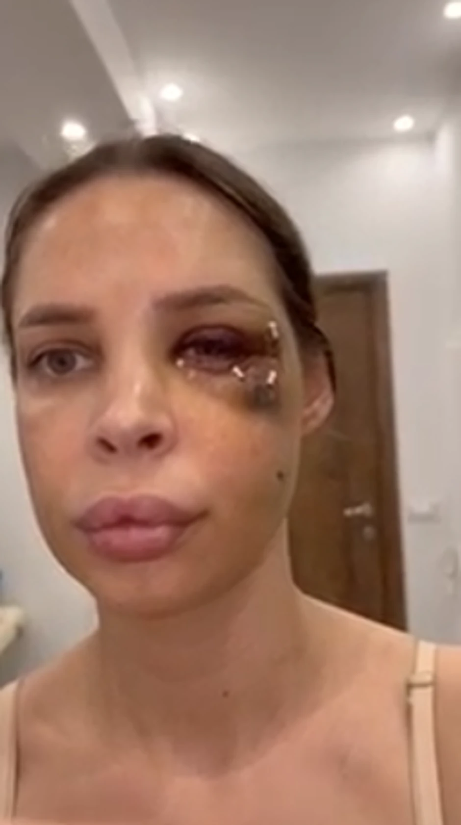 Nataša Šavija nakon operacije