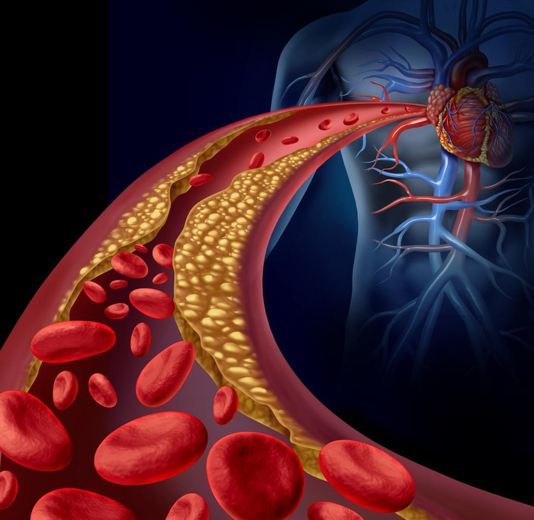 Redukcja cholesterolu LDL (lipoprotein niskiej gęstości)