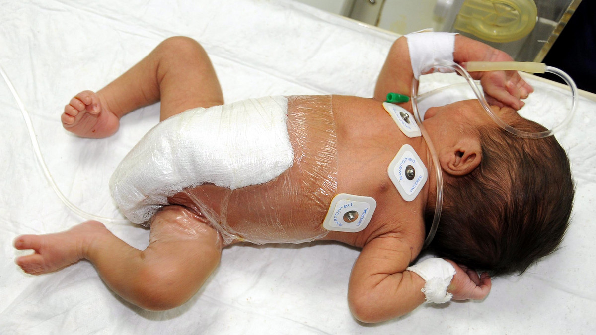 Pakistańscy lekarze pomyślnie przeprowadzili czterogodzinną operację usunięcia czterech zbędnych nóg noworodkowi, który przyszedł na świat z sześcioma kończynami dolnymi - poinformował dyrektor szpitala, gdzie przeprowadzono zabieg.