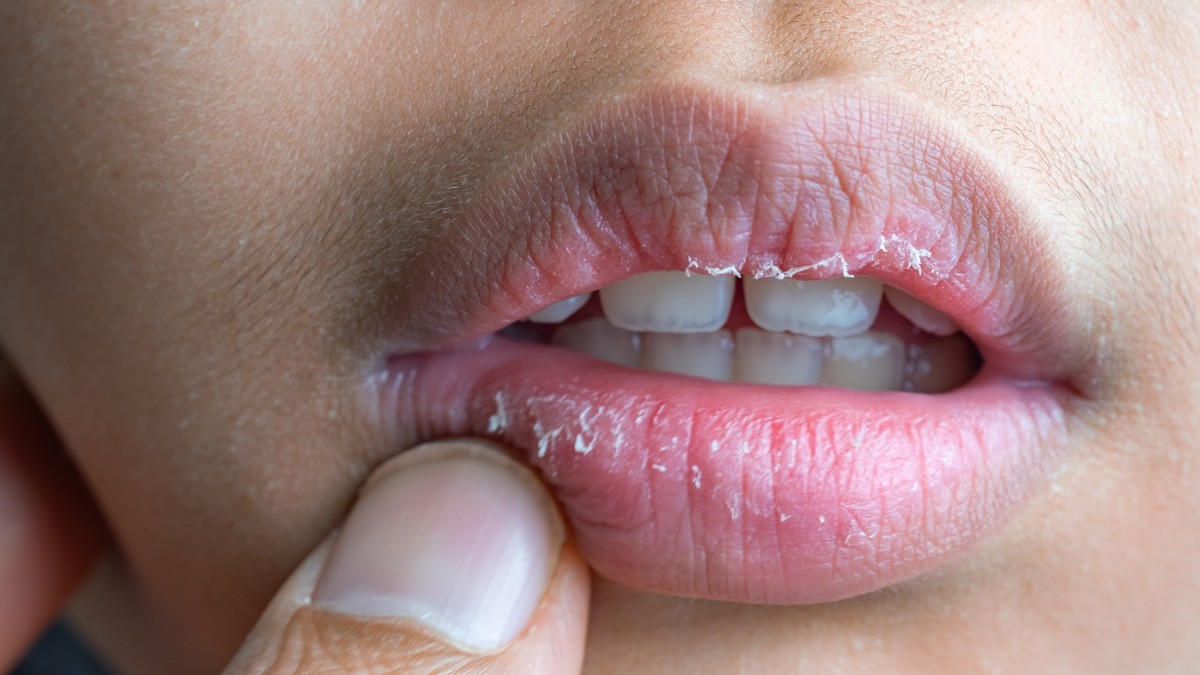 Dermatolog otkriva uzroke suvih i ispucalih usta i kako ih pravilno negovati