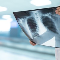 Tüdőgyulladás - még ma is igen veszélyes az influenza gyakori szövődménye