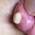 This ear pimple popping video is explosive and horrifying
