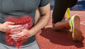 Rak debelog creva kod maratonaca