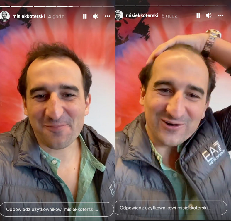 Misiek Koterski poleciał do Turcji zrobić sobie przeszczep włosów
