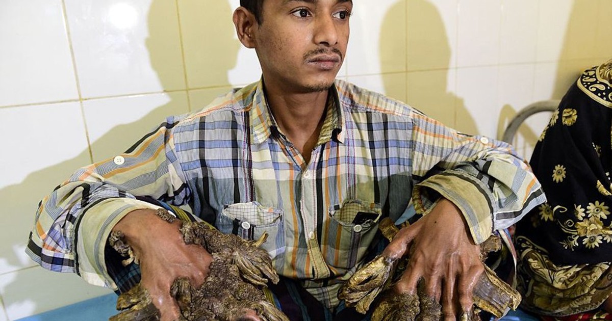 ‘Tree Man’ has surgery to remove barklike warts on his hands Pulse