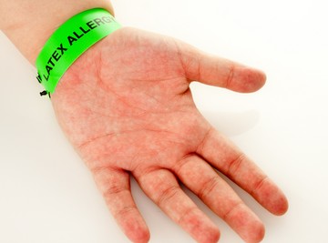 Latex allergia