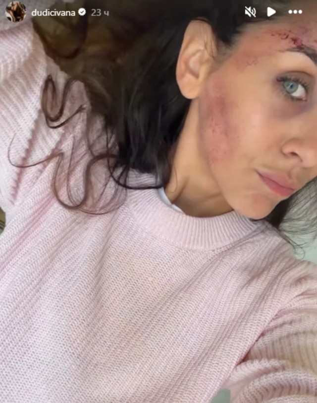 Ivana Dudić sa modricama na licu 