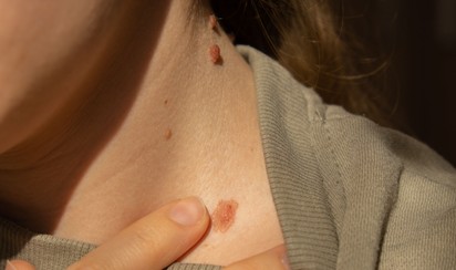 Időben felismerheti a bőrrákot, ha követi ezt az egyszerű módszert!