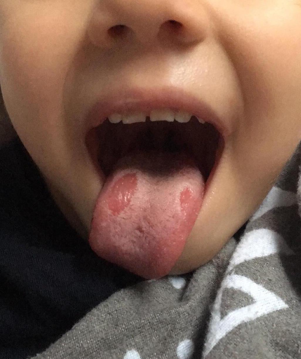 Mapy a povlak na jazyku u detí: Ktorý čo znamená a aké sú príznaky? |  Najmama.sk