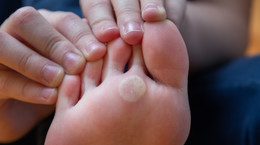 Brodawki na stopie - rodzaje i przyczyny zakażenia. Jak leczyć kurzajki na stopie?