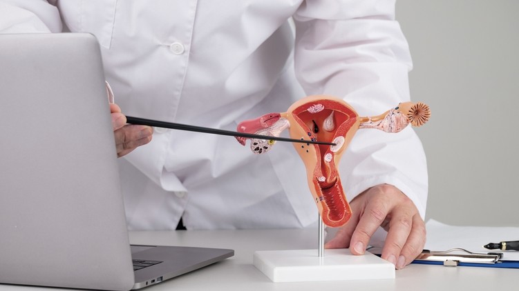 endometriózis, gócok, gyulladás, diagnózis, antitest, gyógyítás, kutatás,